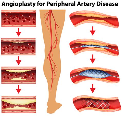 Peripheral Artery Disease Symptoms | Screening & Treatment