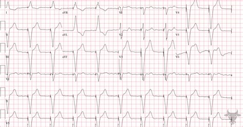 Paced Rhythms | ECG Stampede