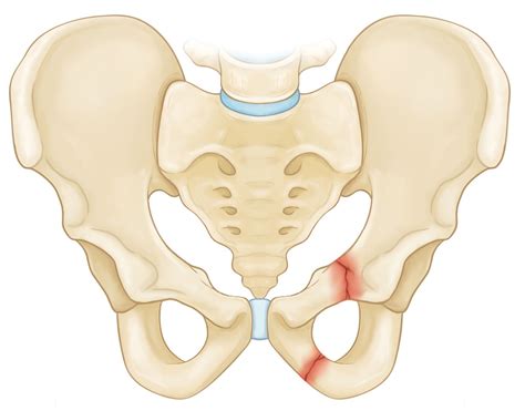 Pelvic Fractures - OrthoInfo - AAOS