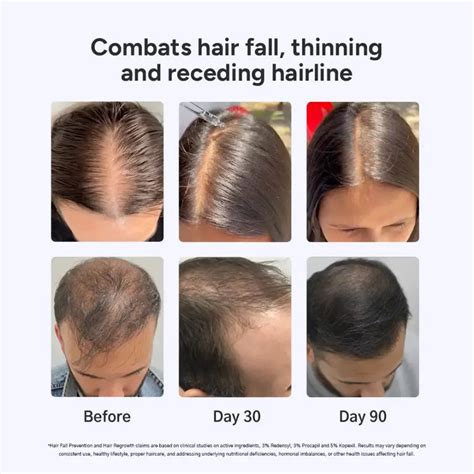 Arata 60-Day Value Pack for Fuller, Denser, Thicker Hair Regrowth | In