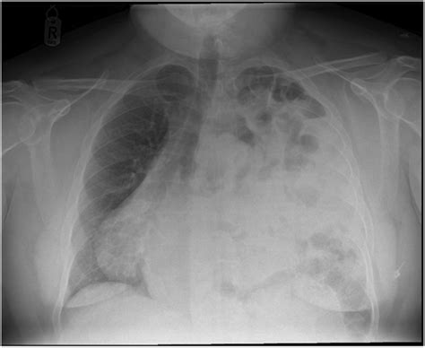 A tale of two unconventional adult diaphragmatic hernias | The Annals ...