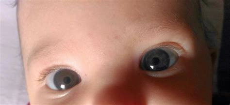 Heterocromia?! | BabyCenter
