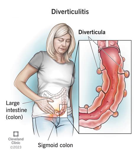 Effective Treatments for Diverticulitis – Ask The Nurse Expert