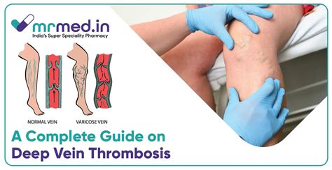 How to Treat Deep Vein Thrombosis (DVT) & Prevent Blood Clots | MrMed
