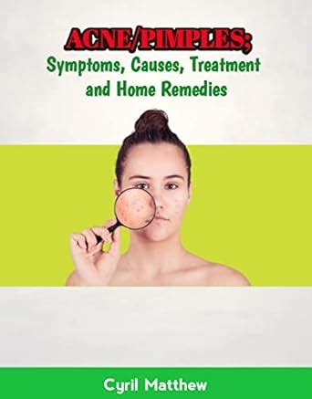 ACNE / PIMPLE; SYMPTOMS, CAUSES, TREATMENT AND HOME REMEDIES: Acne is a ...