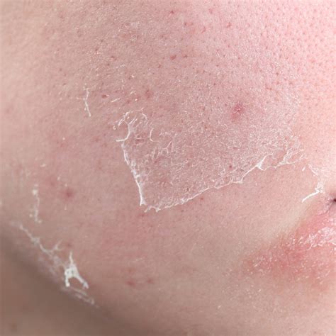 Dry Skin – RBN Organics