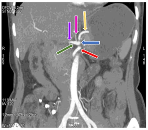 Angiogram Celiac Axis