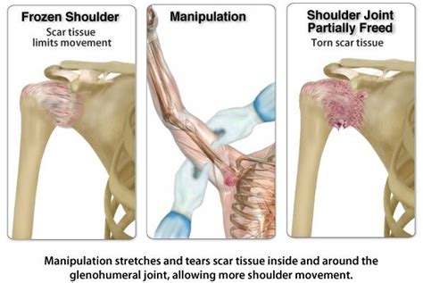 Signs And Symptoms Of Frozen Shoulder