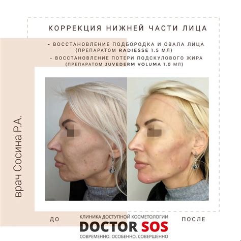 Радиесс (radiesse): отзывы косметологов, пациентов и малышевой, фото до ...