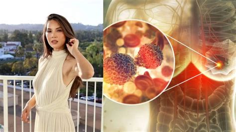 Olivia Munn Says Mammogram Could Not Detect Her Stage One Breast Cancer ...