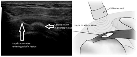 Ultrasound Guided Arthroscopic Removal of Calcific Tendonitis: A ...