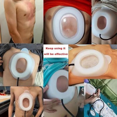 Taeoksn Pectus Excavatum Vacuum Bell - Pectus Excavatum India | Ubuy