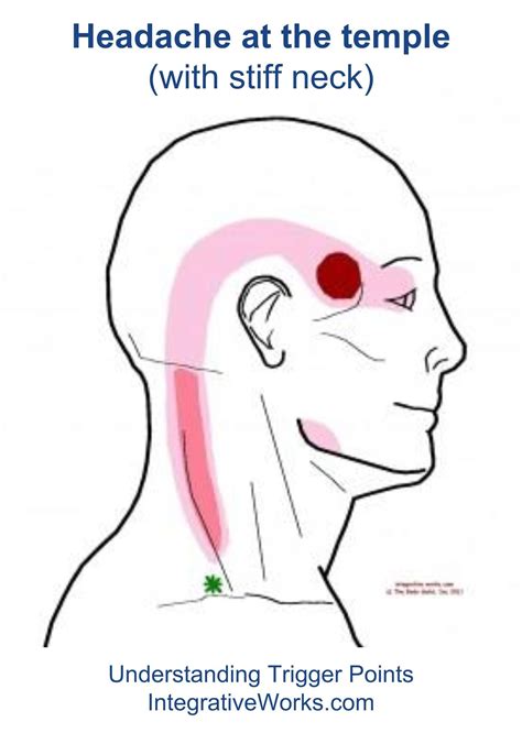 stiff neck | | Integrative Works | Trigger points, Headache remedies, Headache types
