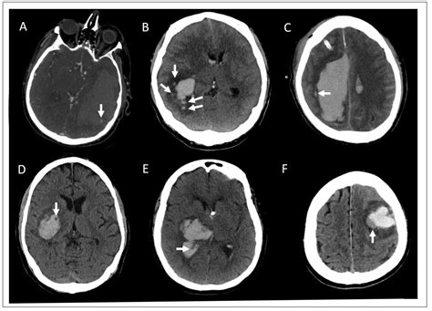 Minimally Invasive Intracerebral Hemorrhage Evacuation Techniques: A Review