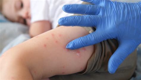 14 measles cases confirmed across Ga. and S.C. this year