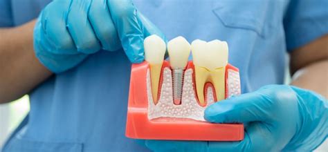 Dental Implant Types, Brands and Costs at Ivory Dental Clinic | Navi Mumbai
