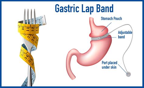 Gastric Banding (Lap Band Surgery) In Iran | Medpersia Medical Tourism