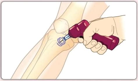 Image result for Intraosseous Access Procedure