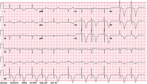 Electrocardiograms in Critical Care Cardiology: Is it Acute Coronary ...