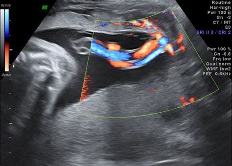 Bildergebnis für velamentous umbilical cord ultrasound