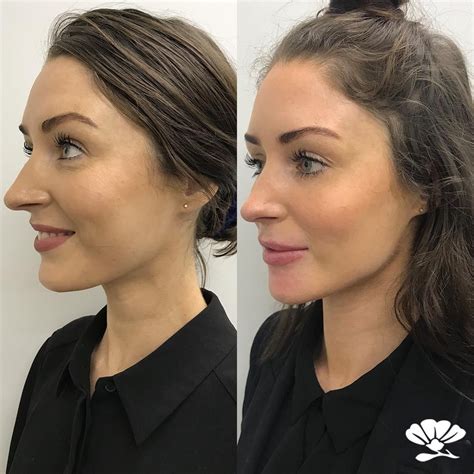 Before and after Dermal Filler to the jawline and chin. Dermal Filler can enhance the structure ...