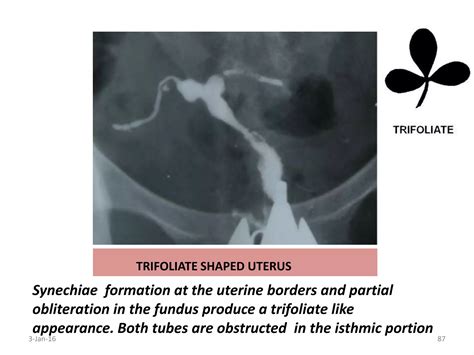 Hysterosalpingography | PPTX