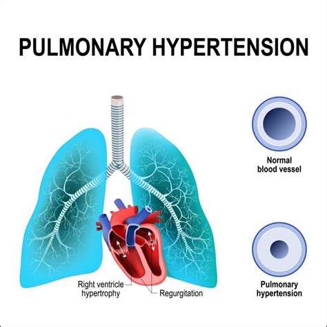 Pulmonary hypertension: Causes, Risk Factors, Symptoms, Treatment