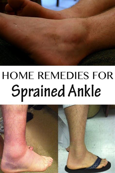 Home Remedies for Sprained Ankle | Sprained ankle, Sprained ankle ...