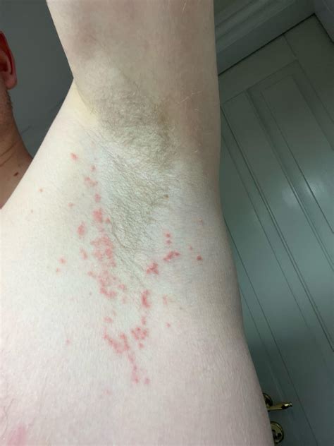 Red Spots in Armpits : r/DermatologyQuestions
