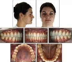 AI may help detect posterior restoration of permanent teeth on ...
