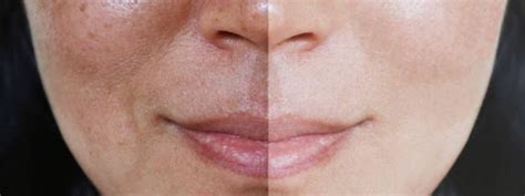 Effective Pigmentation Treatment & Skin Hyperpigmentation Solutions ...