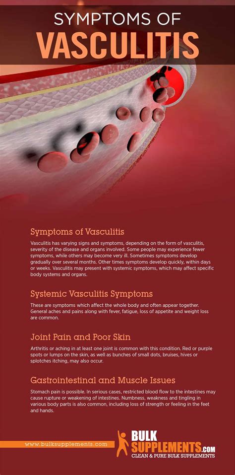 Vasculitis: Symptoms, Causes & Treatment