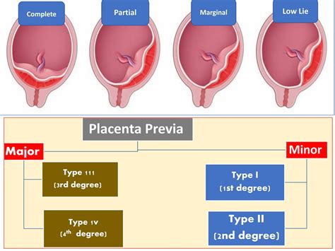 placenta Previa (APHge).pdf
