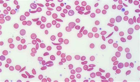 Sickle Cell Blood Smear
