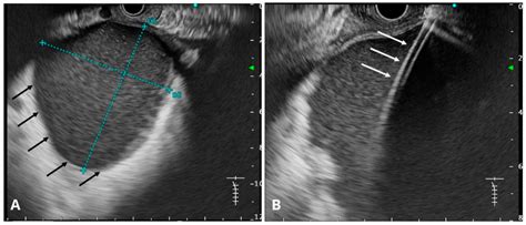Pancreatic Pseudocysts: Evolution of Treatment Approaches