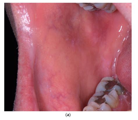 Allopurinol-Induced Oral Lichenoid Drug Reaction with Complete ...