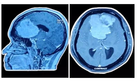 Doctors Successfully Remove a Tennis Ball-Sized Tumor in an 8-Hour Surgery