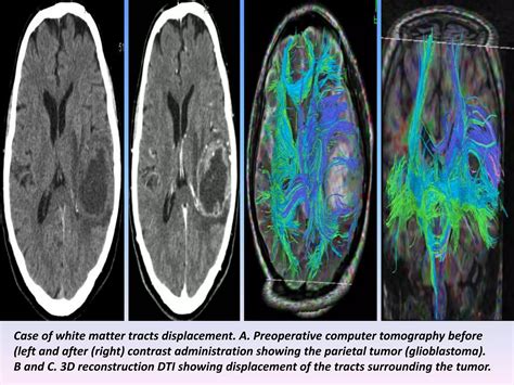 Image result for Diffuse Tensor Imaging