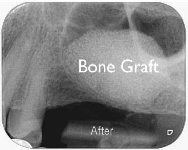 Top Best Dental Implant Treatment and Clinic In Mumbai, Gurgaon, India
