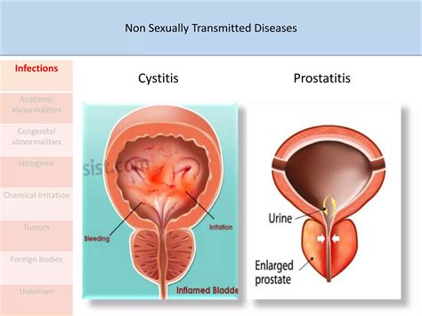 Approach to urethral discharge | PPTX