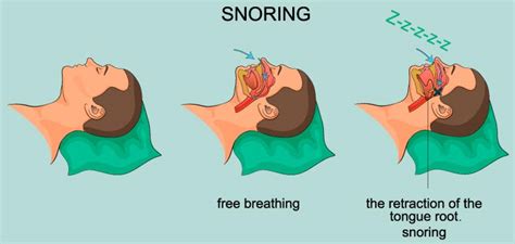 Image result for Sleep Apnea Example