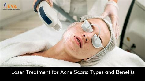 Laser Treatment for Acne Scars: Types and Benefits