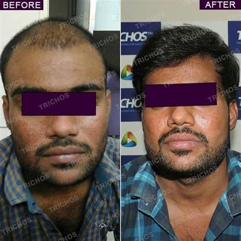 TRICHOS Hair Transplant Center | Campaigns