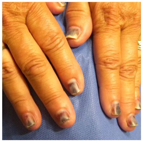 Contact Dermatitis in Nail Cosmetics