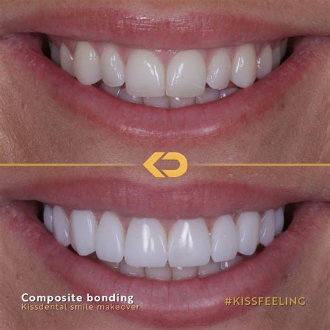 Composite Bonding - Kissdental | Zahntechnik, Zähne