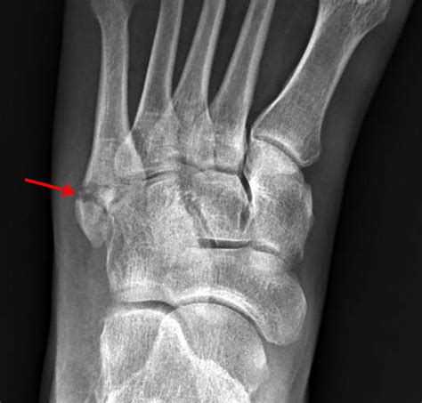 Base Of 5Th Metatarsal Fracture Splint at Jasper Rae blog