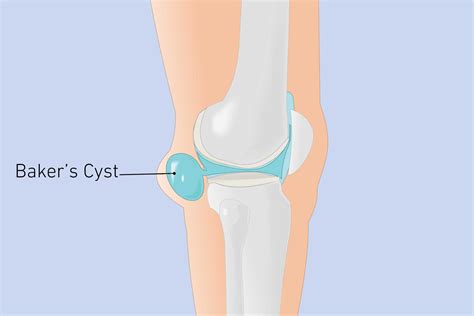 03-bakers-cyst-pain-behind-knee-shutterstock_293981978 | The Healthy