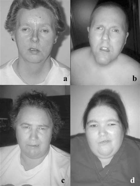 Bardet-Biedl syndrome, causes, symptoms, diagnosis, treatment & prognosis