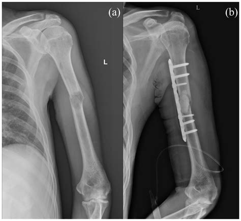 Intramedullary Nail vs. Plate Fixation for Pathological Humeral Shaft Fracture: An Updated ...