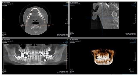 Evaluation of Dental Trauma Splints in Early Permanent Dentition ...